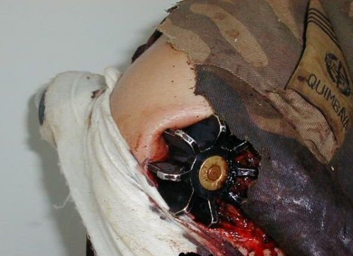 Минометная мина застряла в плече военнослужащего (3 фото)