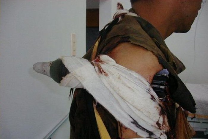 Минометная мина застряла в плече военнослужащего (3 фото)